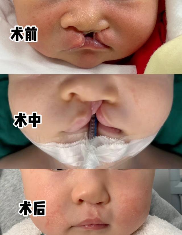 九游娱乐官方入口-对话口腔颌面外科专家陈亦阳:唇腭裂没那么可怕,规范治疗后可与常人无异 | 嫣然医院欠租风波背后
